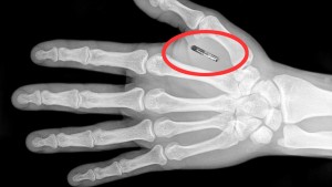 microchip implants